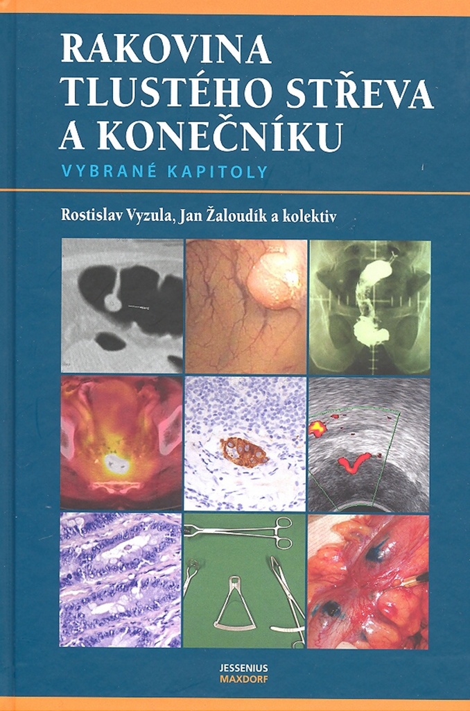 Rakovina tlustého střeva a konečníku - Jan Žaloudík