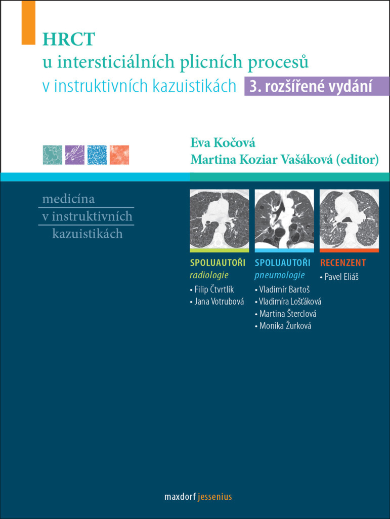 HRCT u intersticiálních plicních procesů v instruktivních kazuistikách - Martina Vašáková